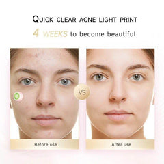 Electronic Acne Patches – Red Light Therapy Zit Patch (6 Pack) - Gardino